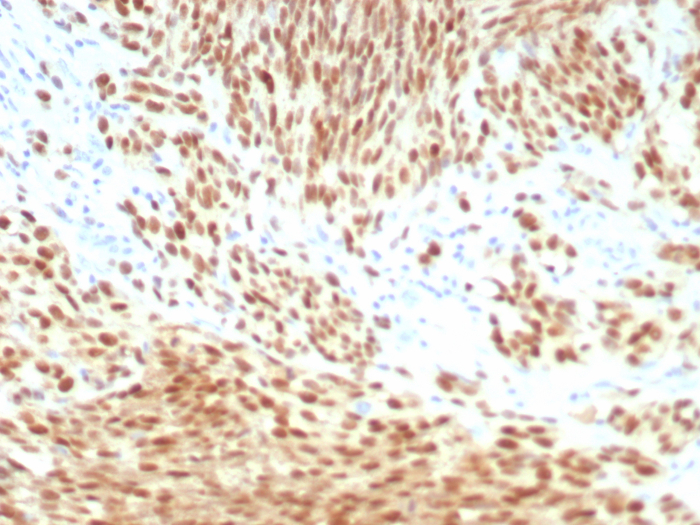 Formalin-fixed, paraffin-embedded human melanoma stained with PRAME antibody (PRAME/8558R). HIER: Tris/EDTA, pH9.0, 45min. Secondary: HRP-polymer, 30min. DAB, 5min.