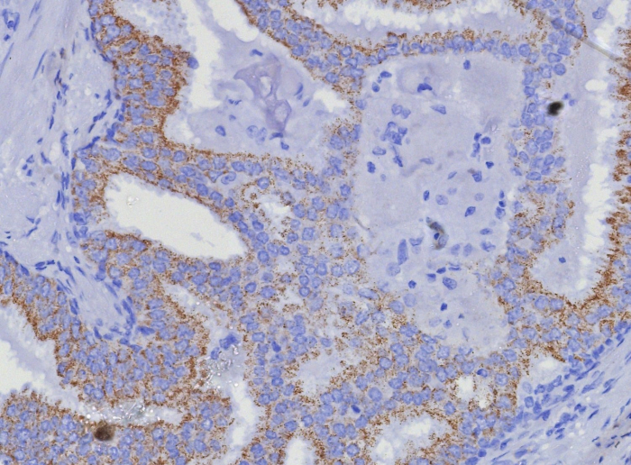 Formalin-fixed, paraffin-embedded human prostate carcinoma stained with alpha-Methylacyl-CoA Racemase/AMACR antibody (AMACR/8350R). HIER: Tris/EDTA, pH9.0, 45min. Secondary: HRP-polymer, 30min. DAB, 5min.