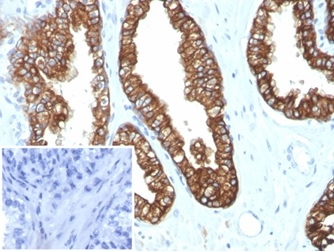 Formalin-fixed, paraffin-embedded human prostate carcinoma stained with Cytokeratin 8/18 antibody (KRT8.18/4997R).18/4997R). Inset: PBS instead of primary antibody; secondary only negative control.