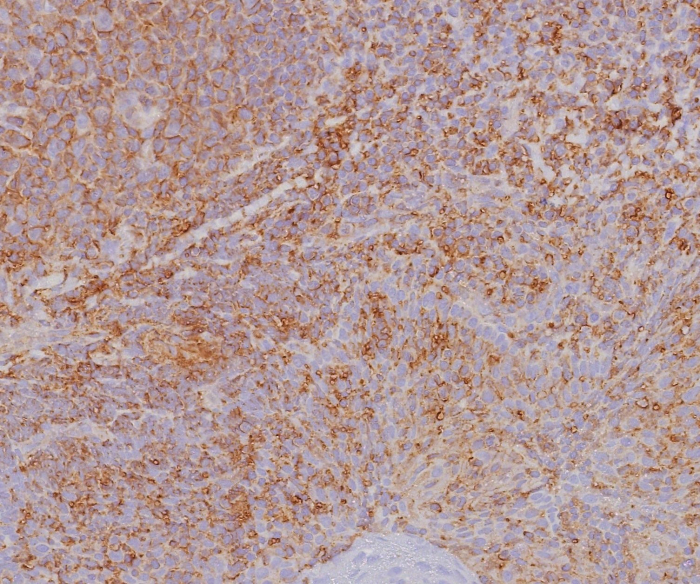 Formalin-fixed, paraffin-embedded human tonsil stained with HLA ABC antibody (MHC-I/8366R). HIER: Tris/EDTA, pH9.0, 45min. 2: HRP-polymer, 30min. DAB, 5min.