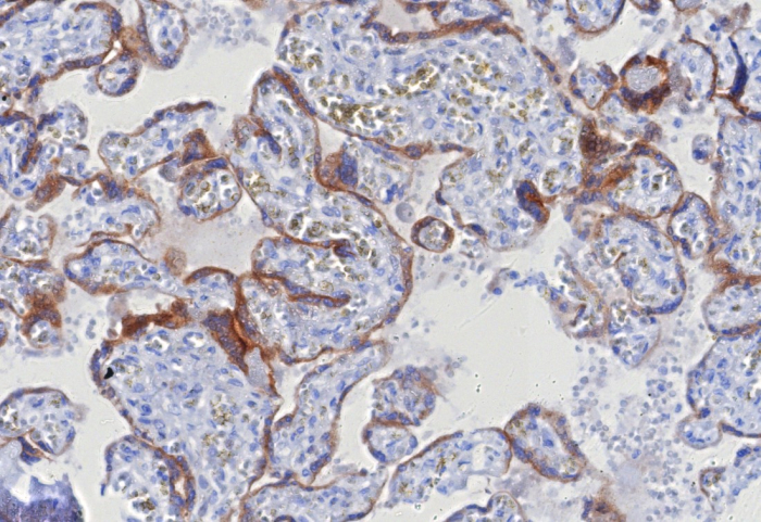 Formalin-fixed, paraffin-embedded human hepatocellular carcinoma stained with Glypican 3 antibody (GPC3/8127R). HIER: Tris/EDTA, pH9.0, 45min. 2: HRP-polymer, 30min. DAB, 5min.