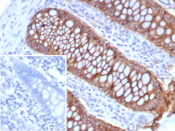 Formalin-fixed, paraffin-embedded human colon stained with Cadherin-17 antibody (rCDH17/8514). Inset: PBS instead of primary antibody; secondary only negative control.