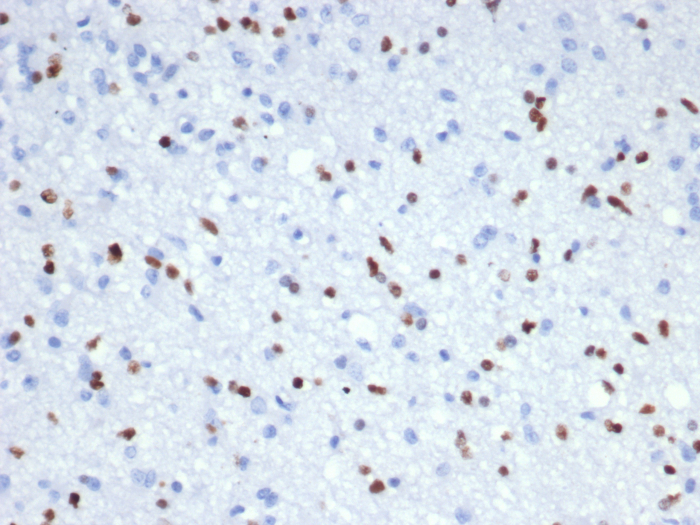 IHC analysis of FFPE human brain (RNA expression: 54.2 nTPM) stained with Olig2 antibody (OLIG2/7366R). HIER: Tris/EDTA, pH9.0, 45min. Secondary: HRP-polymer, 30min. DAB, 5min.
