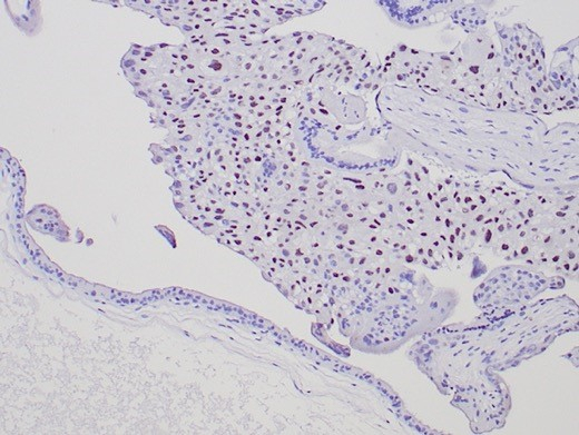IHC analysis of formalin-fixed, paraffin-embedded human complete mole (CM). Strong nuclear staining using p57 Kip2 antibody (KIP2/7187) at 2ug/ml in PBS for 30min RT.