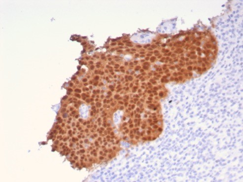 Formalin-fixed, paraffin-embedded human cervical carcinoma stained with p16INK4a/CDKN2A antibody (CDKN2A/8196R). HIER: Tris/EDTA, pH9.0, 45min. Secondary: HRP-polymer, 30min. DAB, 5min.