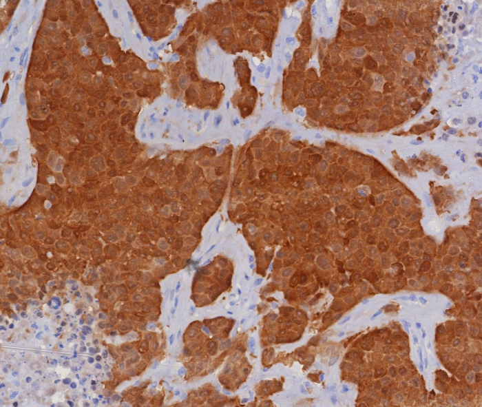 ormalin-fixed, paraffin-embedded human bladder carcinoma stained with p16INK4a/CDKN2A antibody (CDKN2A/8196R). HIER: Tris/EDTA, pH9.0, 45min. Secondary: HRP-polymer, 30min. DAB, 5min.