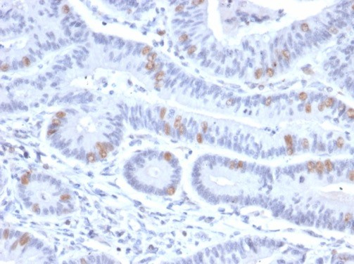Formalin-fixed, paraffin-embedded human colon stained with BRAF35 antibody (PCRP-HMG20B-1B5). HIER: Tris/EDTA, pH9.0, 45min. Secondary: HRP-polymer, 30min. DAB, 5min.