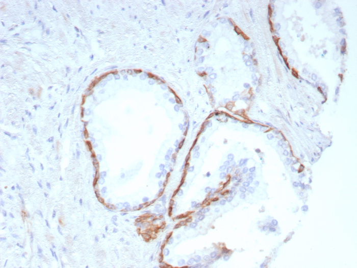 Formalin-fixed, paraffin-embedded human prostate stained with Cytokeratin 14 antibody (KRT14/8691R). HIER: Tris/EDTA, pH9.0, 45min. Secondary: HRP-polymer, 30min. DAB, 5min.