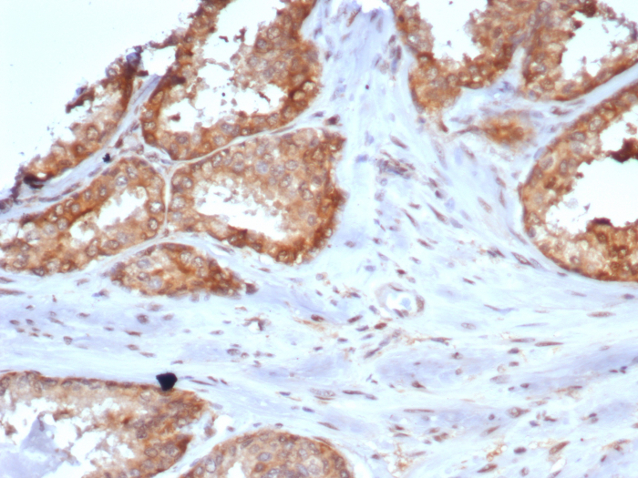 Formalin-fixed, paraffin-embedded human prostate stained with Carm1 antibody (CARM1/7426). HIER: Tris/EDTA, pH9.0, 45min. Secondary: HRP-polymer, 30min. DAB, 5min.