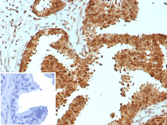 Formalin-fixed, paraffin-embedded human prostate carcinoma stained with Carm1 antibody (CARM1/7426). Inset: PBS instead of primary antibody; secondary only negative control.