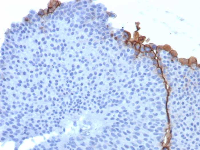 Formalin-fixed, paraffin-embedded human bladder stained with Uroplakin IIIB antibody (UPK3B/3270). HIER: Tris/EDTA, pH9.0, 45min. Secondary: HRP-polymer, 30min. DAB, 5min.