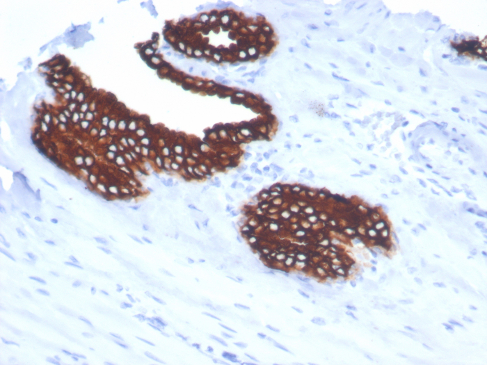Formalin-fixed, paraffin-embedded human prostate stained with Cytokeratin 18 antibody (KRT18/7056R). HIER: Tris/EDTA, pH9.0, 45min. Secondary: HRP-polymer, 30min. DAB, 5min.