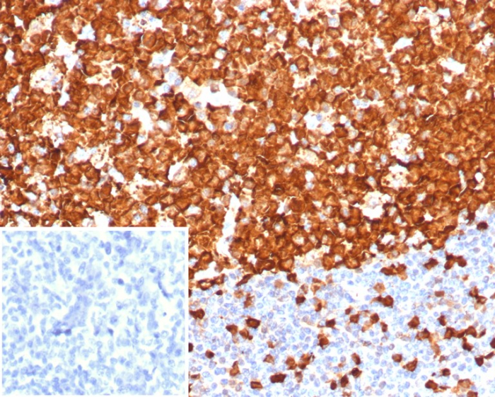 Formalin-fixed, paraffin-embedded human tonsil stained with Stathmin 1 antibody (STMN1/8001R). Inset: PBS instead of primary antibody; secondary only negative control.