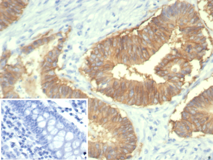 Formalin-fixed, paraffin-embedded human colon stained with EpCAM/TROP1 antibody (rEGP40/7334). Inset: PBS instead of primary antibody; secondary only negative control.