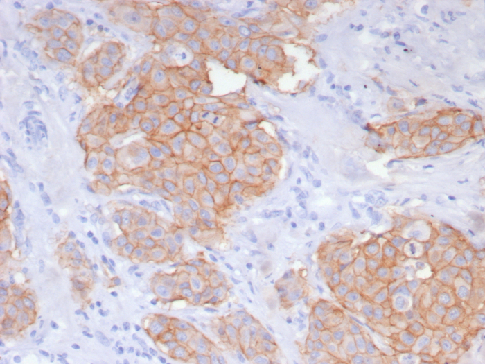 Formalin-fixed, paraffin-embedded human breast carcinoma stained with ErbB2/Her2 antibody (ERBB2/8142R). HIER: Tris/EDTA, pH9.0, 45min. Secondary: HRP-polymer, 30min. DAB, 5min.