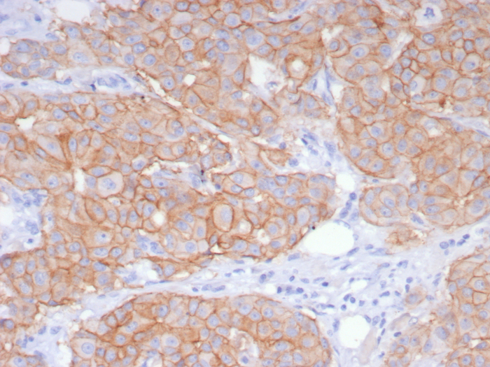 Formalin-fixed, paraffin-embedded human breast carcinoma stained with ErbB2/Her2 antibody (ERBB2/8142R). HIER: Tris/EDTA, pH9.0, 45min. Secondary: HRP-polymer, 30min. DAB, 5min.