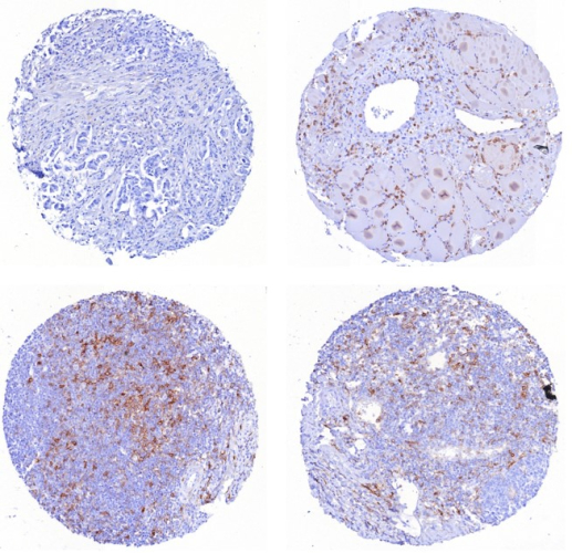 PSGL-1/CD162 antibody (PSGL1/8135R). FFPE human (1) Mammary Carcinoma (2) Transverse muscle (3) Tonsil (4) Tonsil. HIER: Tris/EDTA, pH9.0, 45min. Secondary: HRP-polymer, 30min. DAB, 5min.