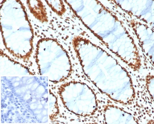 Formalin-fixed, paraffin-embedded human colon stained with Brg1 antibody (BRG1/6531R). Inset: PBS instead of primary antibody; secondary only negative control.