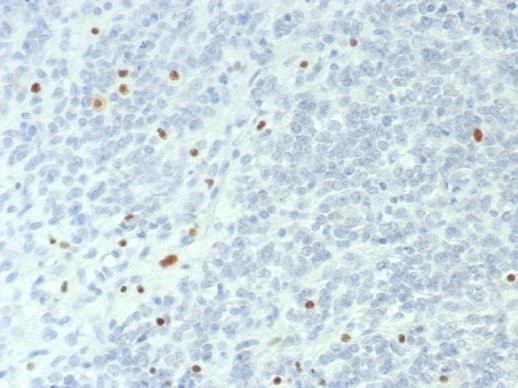 Formalin-fixed, paraffin-embedded human ovarian small cell carcinoma stained with Brg1 antibody (BRG1/6531R). HIER: Tris/EDTA, pH9.0, 45min. Secondary: HRP-polymer, 30min. DAB, 5min.