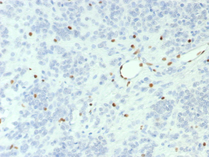 Formalin-fixed, paraffin-embedded human ovarian small cell carcinoma stained with Brg1 antibody (BRG1/7633R). HIER: Tris/EDTA, pH9.0, 45min. Secondary: HRP-polymer, 30min. DAB, 5min.