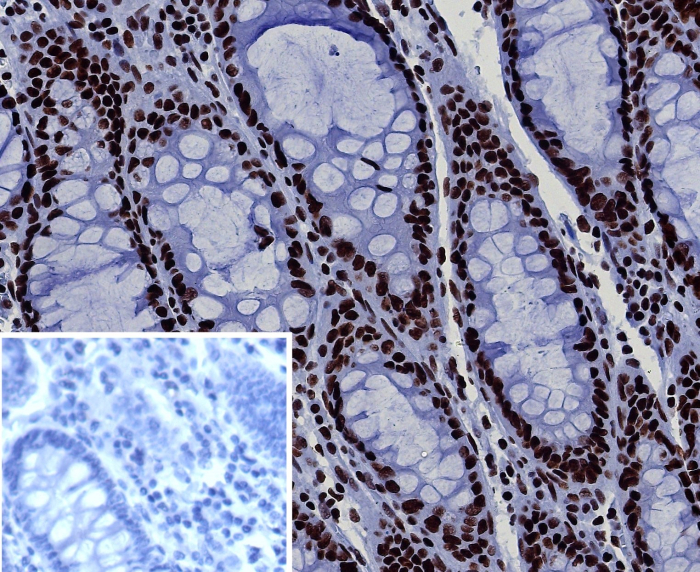 Formalin-fixed, paraffin-embedded human colon stained with Brg1 antibody (BRG1/7633R). Inset: PBS instead of primary antibody; secondary only negative control.