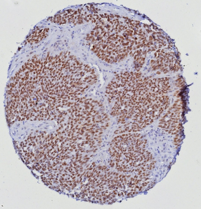 Formalin-fixed, paraffin-embedded human prostate tissue stained with ERG antibody (ERG/6980). HIER: Tris/EDTA pH 9; 95C/45min. SecondaryAb: HRP-Polymer:30mins; DAB: 5min.