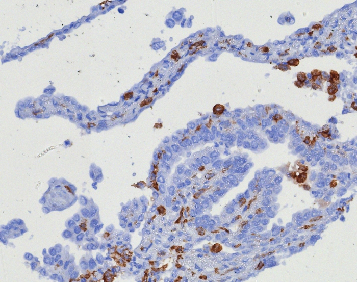 Formalin-fixed, paraffin-embedded human ovarian carcinoma stained with CD163 antibody (M130/8361R). HIER: Tris/EDTA, pH9.0, 45min. 2: HRP-polymer, 30min. DAB, 5min.