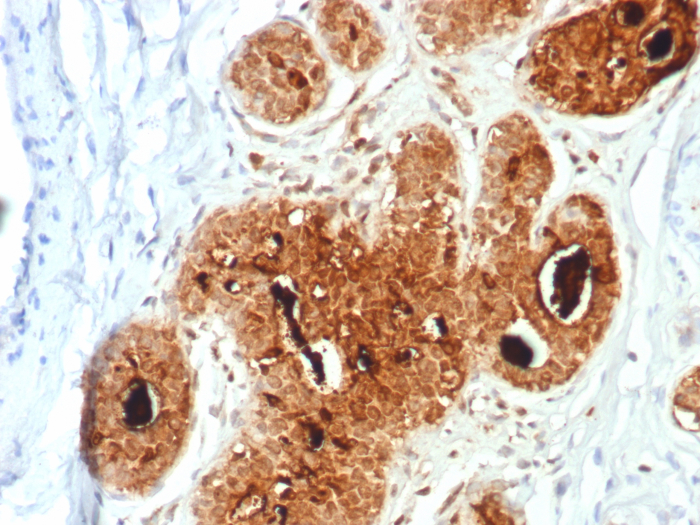 Formalin-fixed, paraffin-embedded human breast carcinoma stained with PIP antibody (PIP/7477). HIER: Tris/EDTA, pH9.0, 45min. Secondary: HRP-polymer, 30min. DAB, 5min.