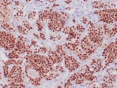 Formalin-fixed, paraffin-embedded human pituitary stained with POU1F1 / PIT-1 Mouse Monoclonal Antibody (PIT1/7262). HIER: Tris/EDTA, pH9.0, 45min. 2: HRP-polymer, 30min. DAB, 5min.