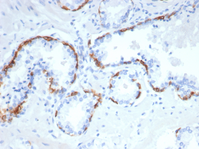 Formalin-fixed, paraffin-embedded human prostate stained with Cytokeratin 14 antibody (rKRT14/7290). HIER: Tris/EDTA, pH9.0, 45min. Secondary: HRP-polymer, 30min. DAB, 5min.