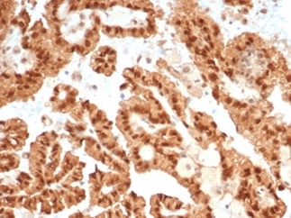 Formalin-fixed, paraffin-embedded human renal cell carcinoma stained with STAT6 antibody (STAT6/7163R).