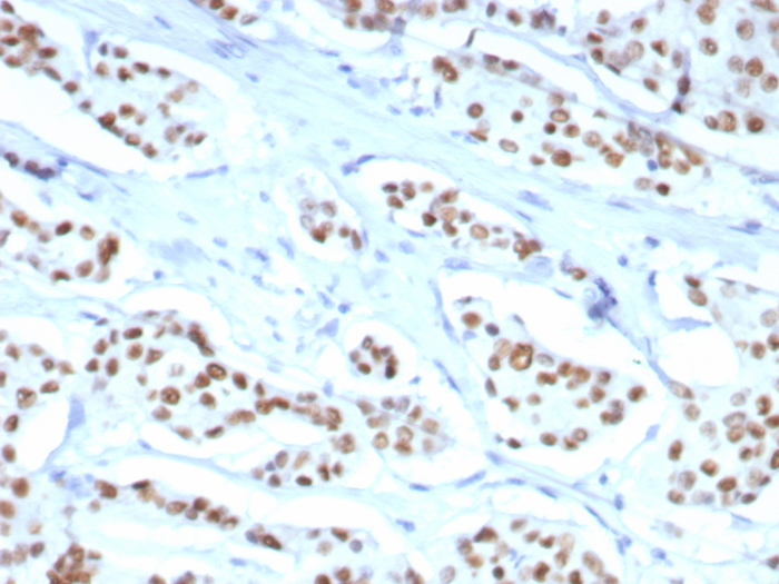 Formalin fixed paraffin embedded human breast carcinoma stained with ER alpha/NR3A1 antibody (ESR1/8407R). HIER: Tris/EDTA, pH9.0, 45min. 2: HRP-polymer, 30min. DAB, 5min.