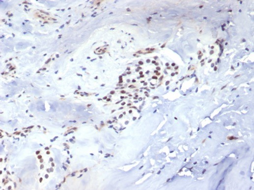 Formalin-fixed, paraffin-embedded human parathyroid stained with Brachyury antibody (TBXT/7711R). HIER: Tris/EDTA, pH9.0, 45min. Secondary: HRP-polymer, 30min. DAB, 5min.