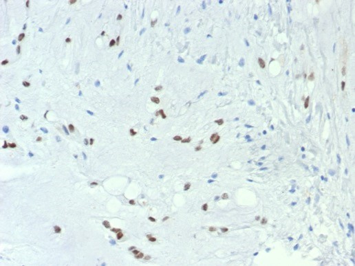 Formalin-fixed, paraffin-embedded human chordoma stained with Brachyury antibody (TBXT/7711R). HIER: Tris/EDTA, pH9.0, 45min. Secondary: HRP-polymer, 30min. DAB, 5min.