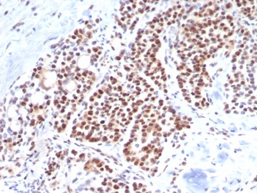 Formalin-fixed, paraffin-embedded human parathyroid stained with Brachyury antibody (TBXT/7853R). HIER: Tris/EDTA, pH9.0, 45min. Secondary: HRP-polymer, 30min. DAB, 5min.