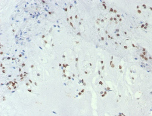 Formalin-fixed, paraffin-embedded human chordoma stained with Brachyury antibody (TBXT/7853R). HIER: Tris/EDTA, pH9.0, 45min. Secondary: HRP-polymer, 30min. DAB, 5min.