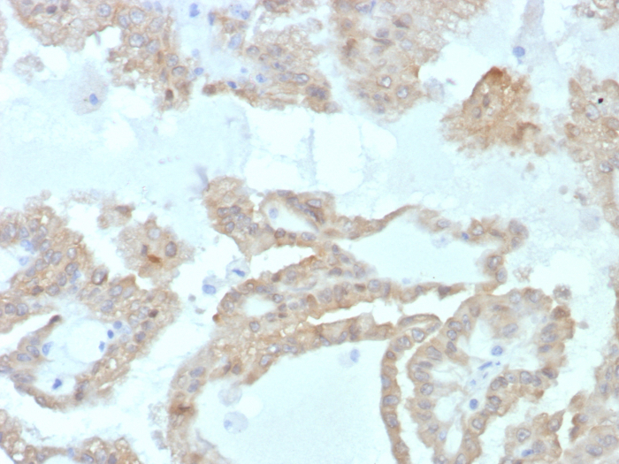 Formalin-fixed, paraffin-embedded human renal cell carcinoma stained with FABP2/I-FABP antibody (FABP2/7669). HIER: Tris/EDTA, pH9.0, 45min. Secondary: HRP-polymer, 30min. DAB, 5min.