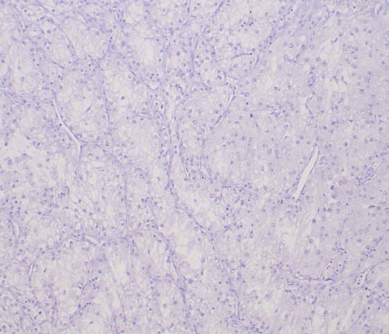 IHC analysis of formalin-fixed, paraffin-embedded human clear cell RCC. Negative tissue control using Transcription factor E3 antibody (TFE3/6849R) at 2ug/ml in PBS for 30min RT. HIER: Tris/EDTA, pH9.0, 45min. Secondary: HRP-polymer, 30min. DAB, 5min.