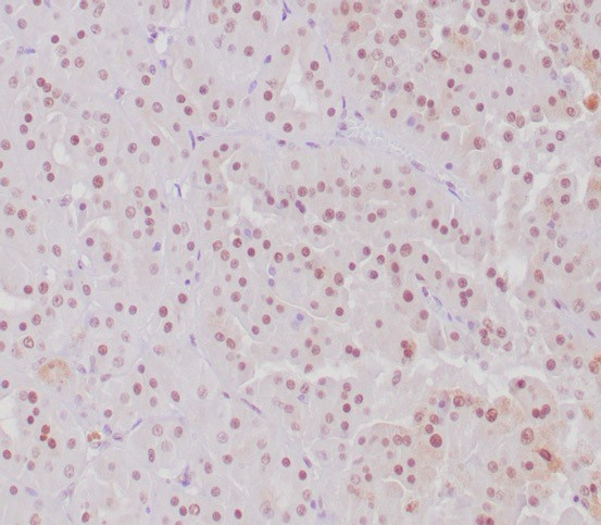 IHC analysis of formalin-fixed, paraffin-embedded human MiT translocation RCC. Nuclear staining using Transcription factor E3 antibody (TFE3/6849R) at 2ug/ml. HIER: Tris/EDTA, pH9.0, 45min. Secondary: HRP-polymer, 30min. DAB, 5min.