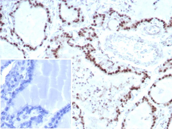 IHC analysis of formalin-fixed, paraffin-embedded human thyroid. Nuclear staining using Transcription factor E3 antibody (TFE3/8663R) at 2ug/ml. Inset: PBS instead of primary antibody; secondary only negative control.