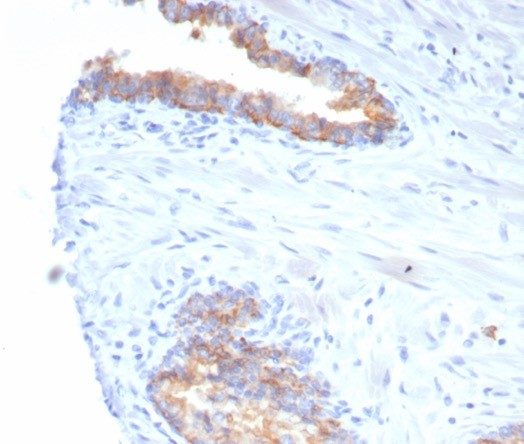 IHC analysis of formalin-fixed, paraffin-embedded human prostate carcinoma. Strong cytoplasmic and membranous staining using CD38 antibody (rCD38/6982) at 2ug/ml in PBS for 30min RT. HIER: Tris/EDTA, pH9.0, 45min. Secondary: HRP-polymer, 30min. DAB, 5min.