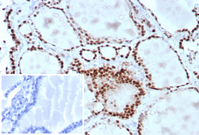 Formalin-fixed, paraffin-embedded human lung adenocarcinoma stained with TTF-1 / NKX2-1 antibody (TTF1/8430). Inset: PBS instead of primary antibody; secondary only negative control.