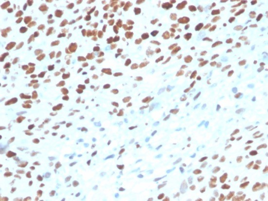 Formalin-fixed, paraffin-embedded human bladder stained with p53 antibody (rTP53/3889).