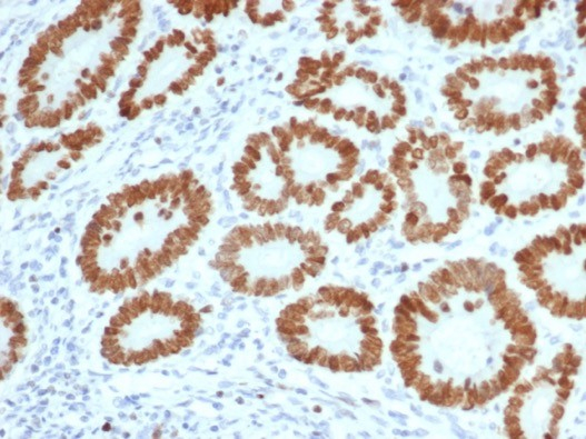 IHC analysis of formalin-fixed, paraffin-embedded human colon. Strong nuclear staining using SATB2 antibody (SATB2/7111) at 2ug/ml in PBS for 30min RT. HIER: Tris/EDTA, pH9.0, 45min. Secondary: HRP-polymer, 30min. DAB, 5min.