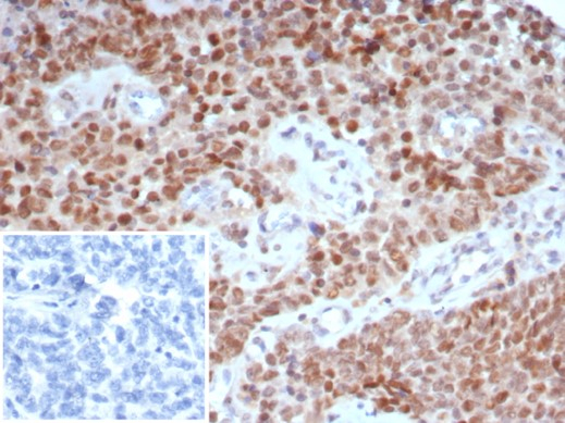 Formalin-fixed, paraffin-embedded human ovary stained with TRPS1 antibody (TRPS1/7912R). Inset: PBS instead of primary antibody; secondary only negative control.