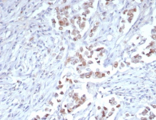 IHC analysis of formalin-fixed, paraffin-embedded human breast carcinoma. Strong nuclear staining using TRPS1 antibody (TRPS1/7912R) at 2ug/ml in PBS for 30min RT. HIER: Tris/EDTA, pH9.0, 45min. Secondary: HRP-polymer, 30min. DAB, 5min.