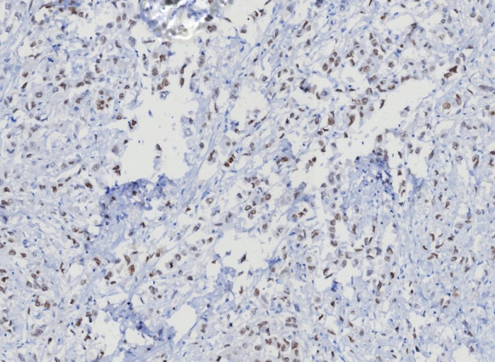 IHC analysis of formalin-fixed, paraffin-embedded human uterus. Strong nuclear staining using TRPS1 antibody (TRPS1/8008R) at 2ug/ml. HIER: Tris/EDTA, pH9.0, 45min. 2: HRP-polymer, 30min. DAB, 5min.