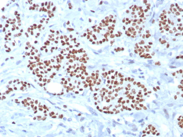 IHC analysis of formalin-fixed, paraffin-embedded human breast carcinoma. Strong nuclear staining using TRPS1 antibody (TRPS1/8008R) at 2ug/ml. HIER: Tris/EDTA, pH9.0, 45min. 2: HRP-polymer, 30min. DAB, 5min.