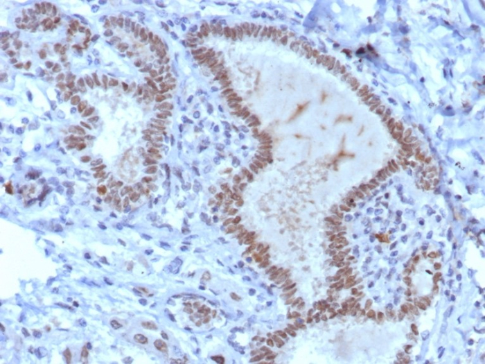 IHC analysis of formalin-fixed, paraffin-embedded human triple negative breast carcinoma. Strong nuclear staining using TRPS1 antibody (TRPS1/8008R) at 2ug/ml. HIER: Tris/EDTA, pH9.0, 45min. 2: HRP-polymer, 30min. DAB, 5min.