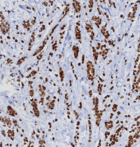 FFPE human mammary gland carcinoma stained with TRPS1 antibody (TRPS1/8008R). HIER: Tris/EDTA, pH9.0, 45min. Secondary: HRP-polymer, 30min. DAB, 5min.